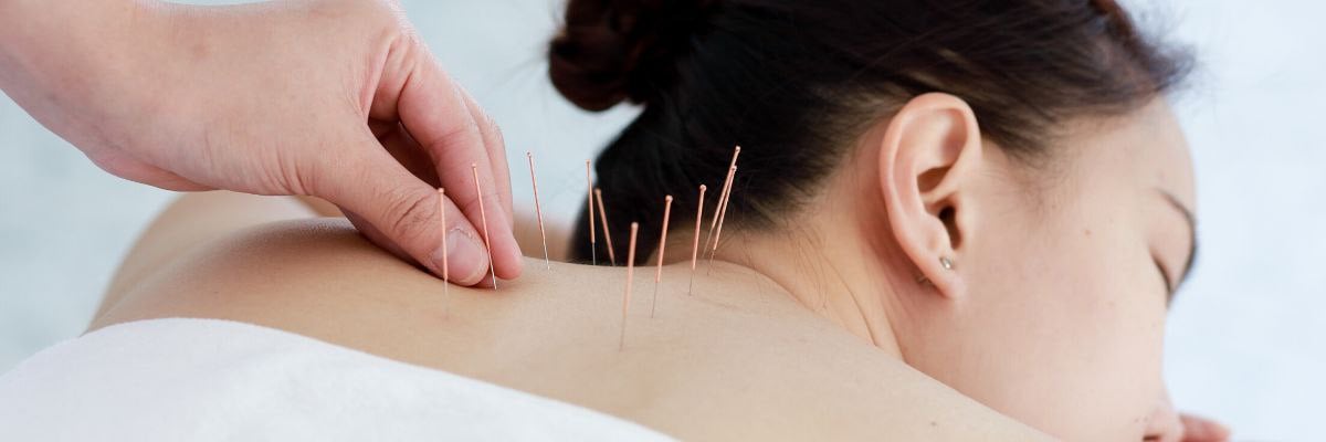 Fertility Acupuncture 101: How Does Acupuncture Work?